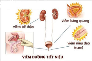 benh-duong-tiet-nieu-1