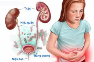 viem-duong-tiet-nieu