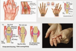 viêm khớp dạng thấp