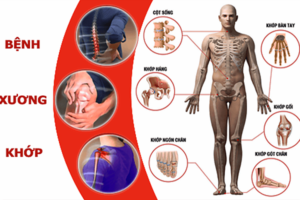 bệnh cơ xương khớp