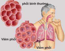 hình ảnh mô tả viêm phổi