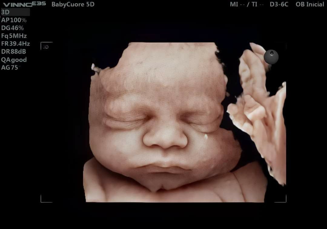 Hình ảnh siêu âm thai nhi trên nền máy siêu âm Vinno E35